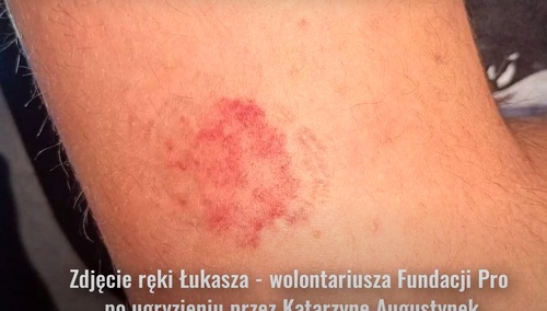 Ręka wolontariusza Fundacji Pro - Prawo do życia, jak twierdzi Fundacja, ugryziona przez "Babcię Kasię"