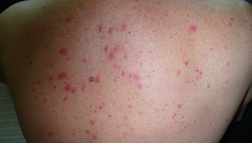 Kolejne przypadki małpiej ospy w Europie. Ogłoszono alert sanitarny