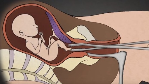 [Sondaż] Trzy czwarte Amerykanów chce zaostrzenia prawa aborcyjnego