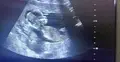 Ultrasonograficzne zdjęcie płodu ludzkiego w wieku 13 tygodni i 6 dni